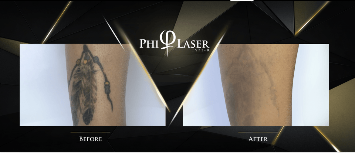 PhiLaser Tattoo Removal Training